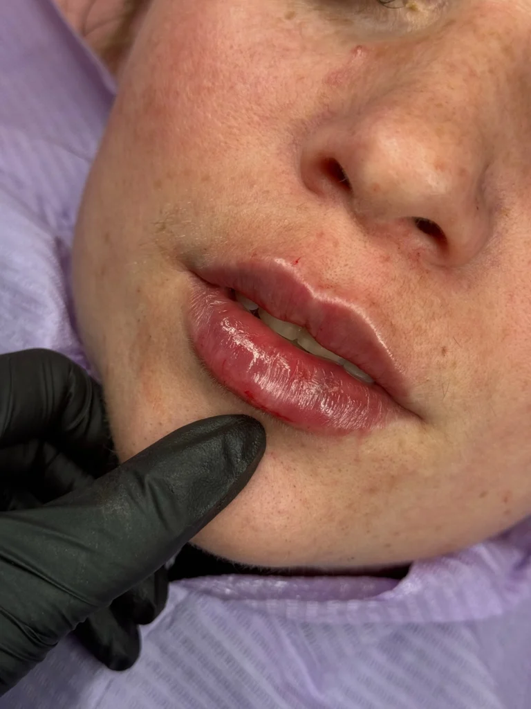 Lip Filler in Greenford