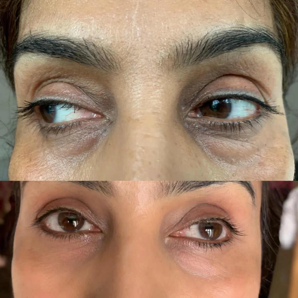 CO2 Laser Treatment for Eyes in Ealing