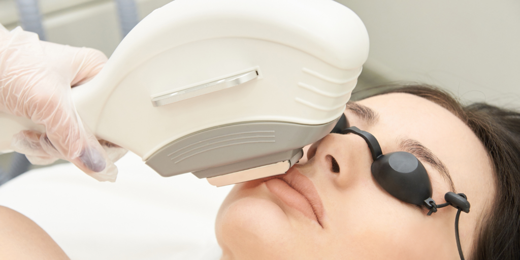 IPL Treatment in Pinner