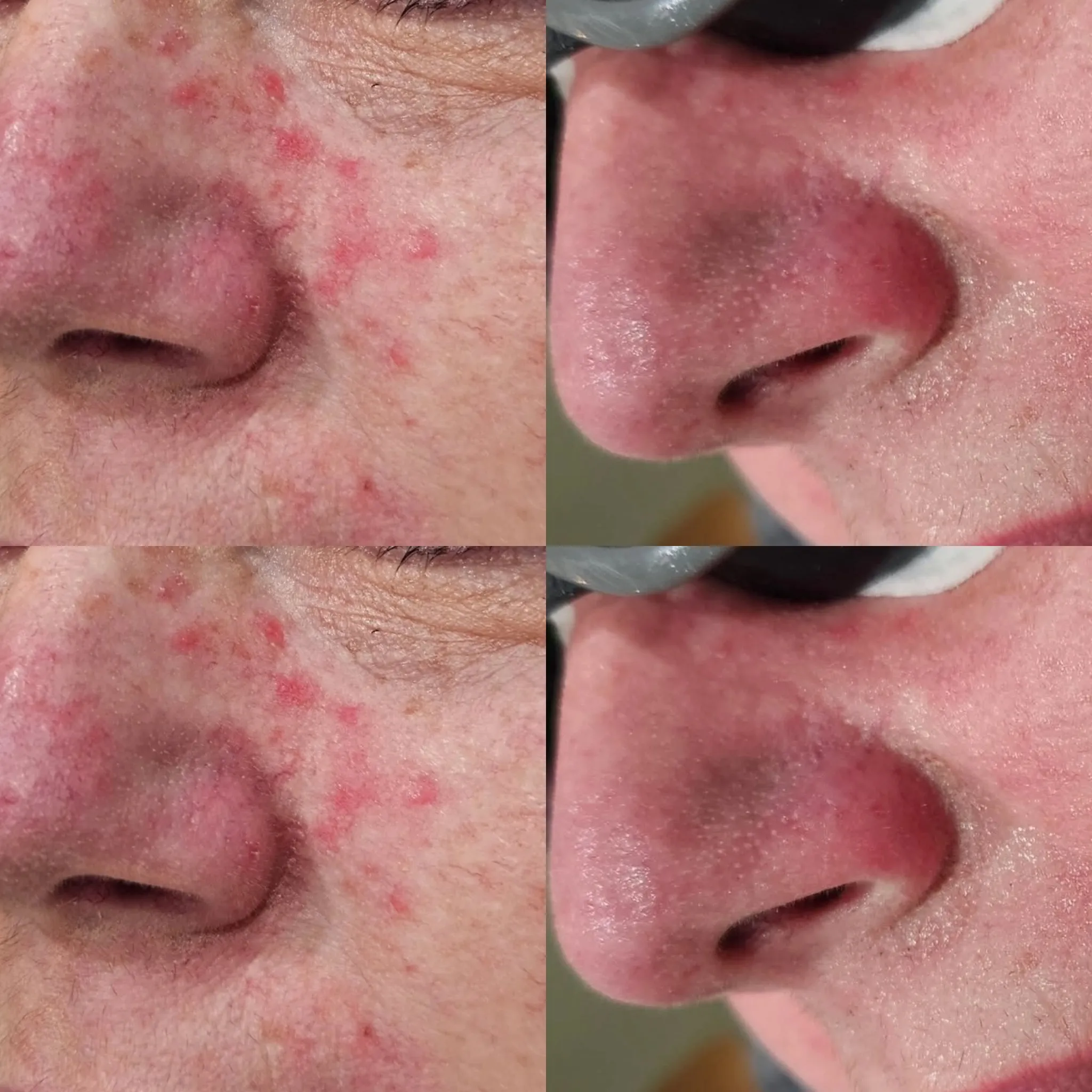 Acne Treatment in Harrow on the Hill