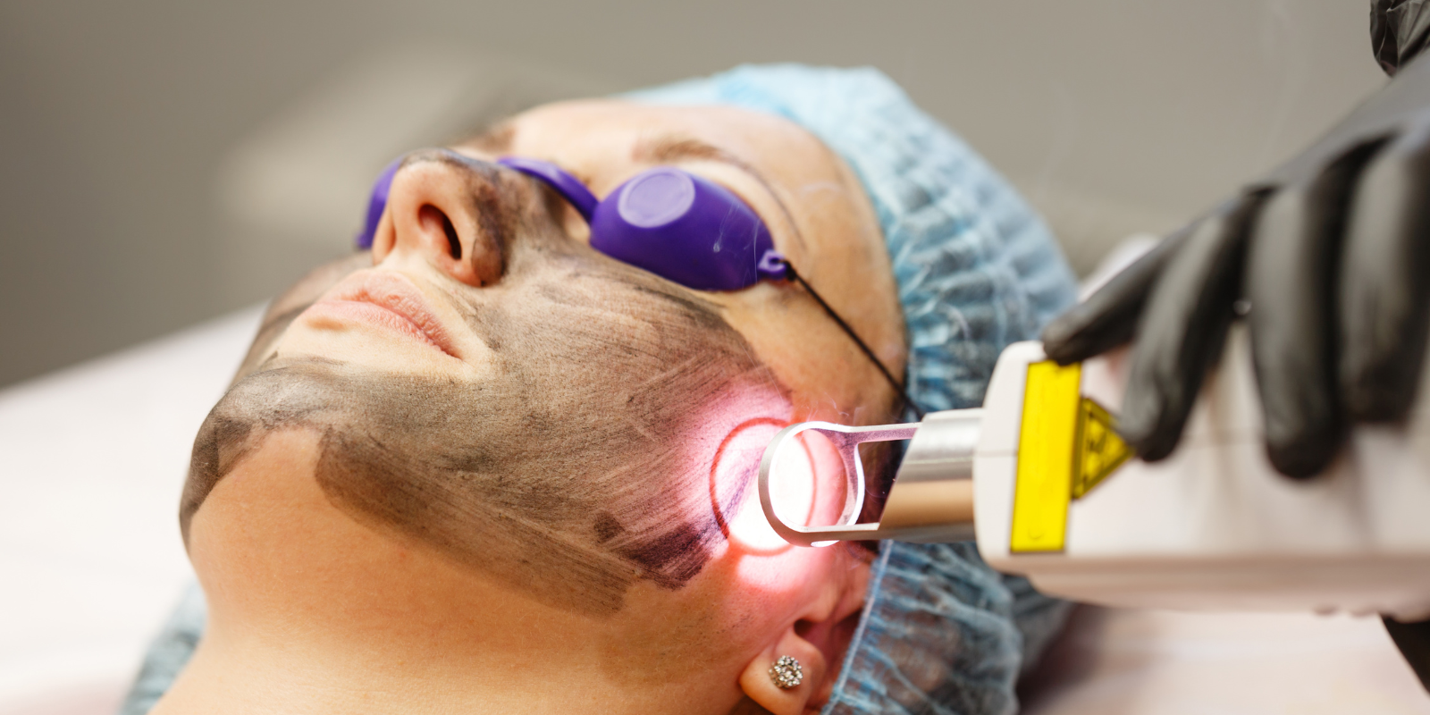 Co2 Laser in Edgware