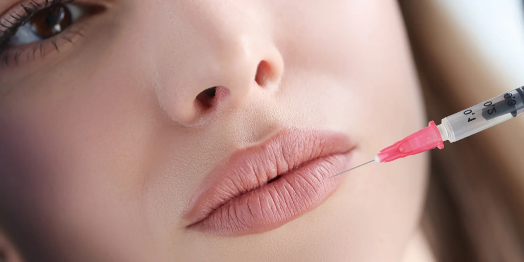 Lip Filler Treatment in Stanmore