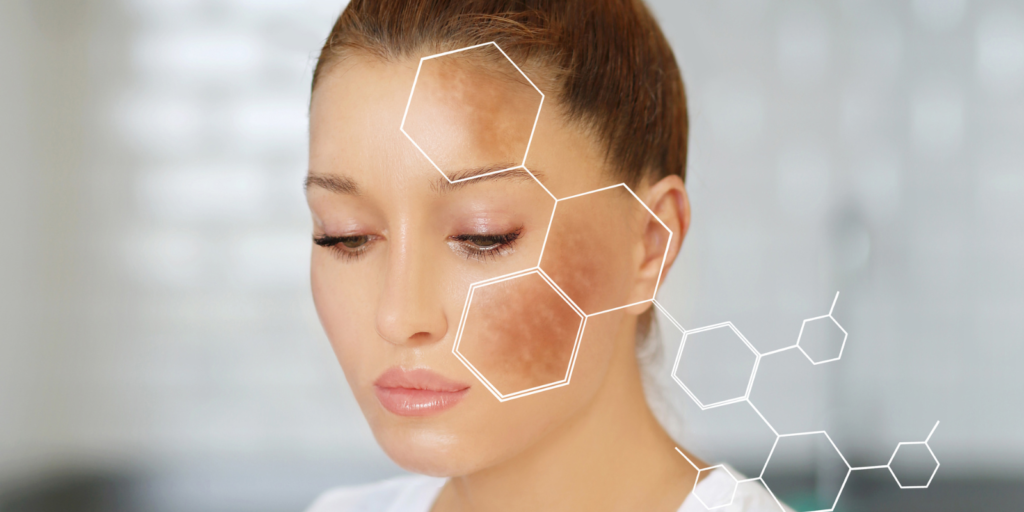 freckle facial treatments in Harrow on the Hill
