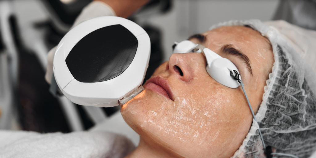 Co2 laser Treatment In Edgware