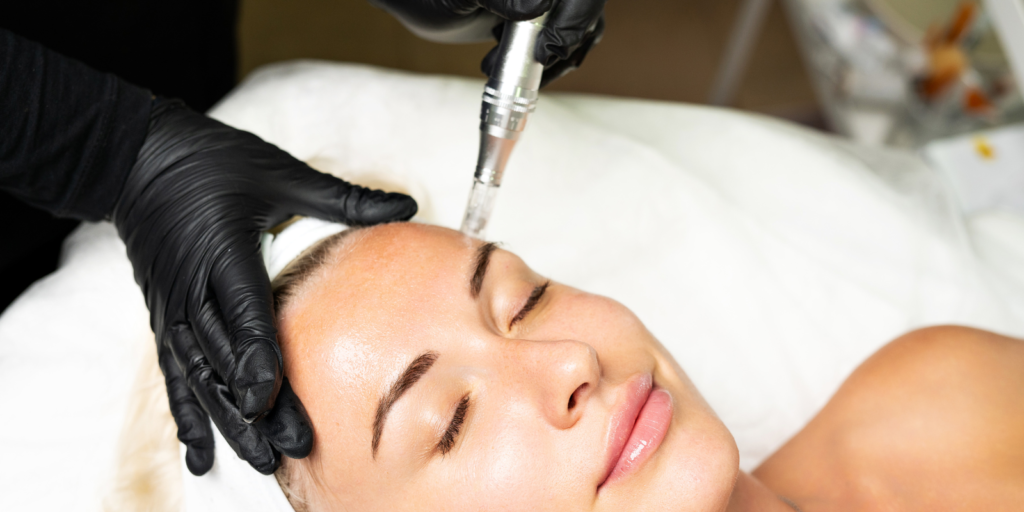 Microneedling with Exosomes in Harrow