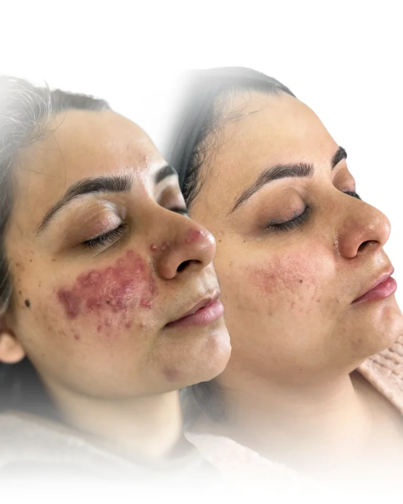 Pigmentation peel Services in Harrow