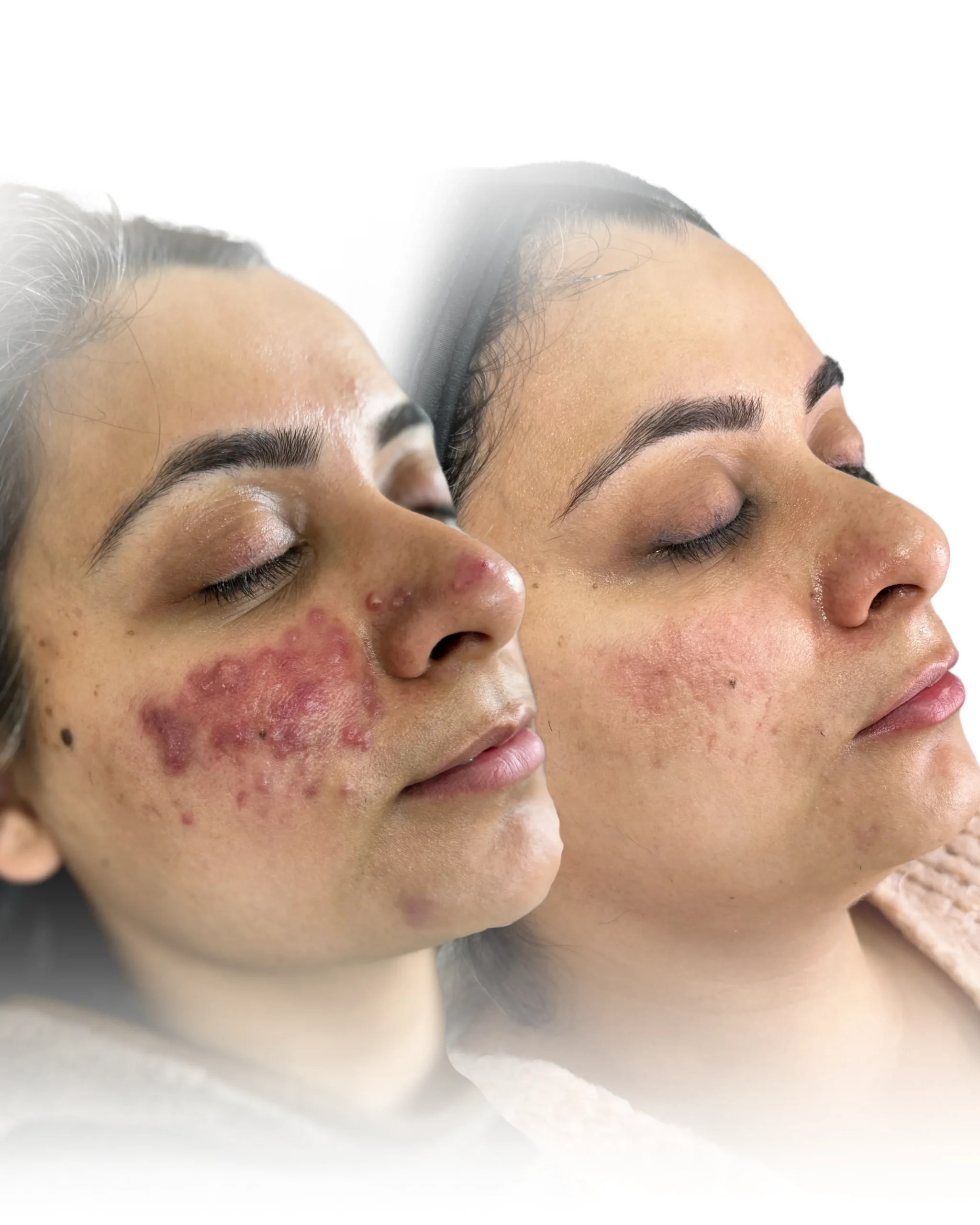 Pigmentation peel Services in Harrow