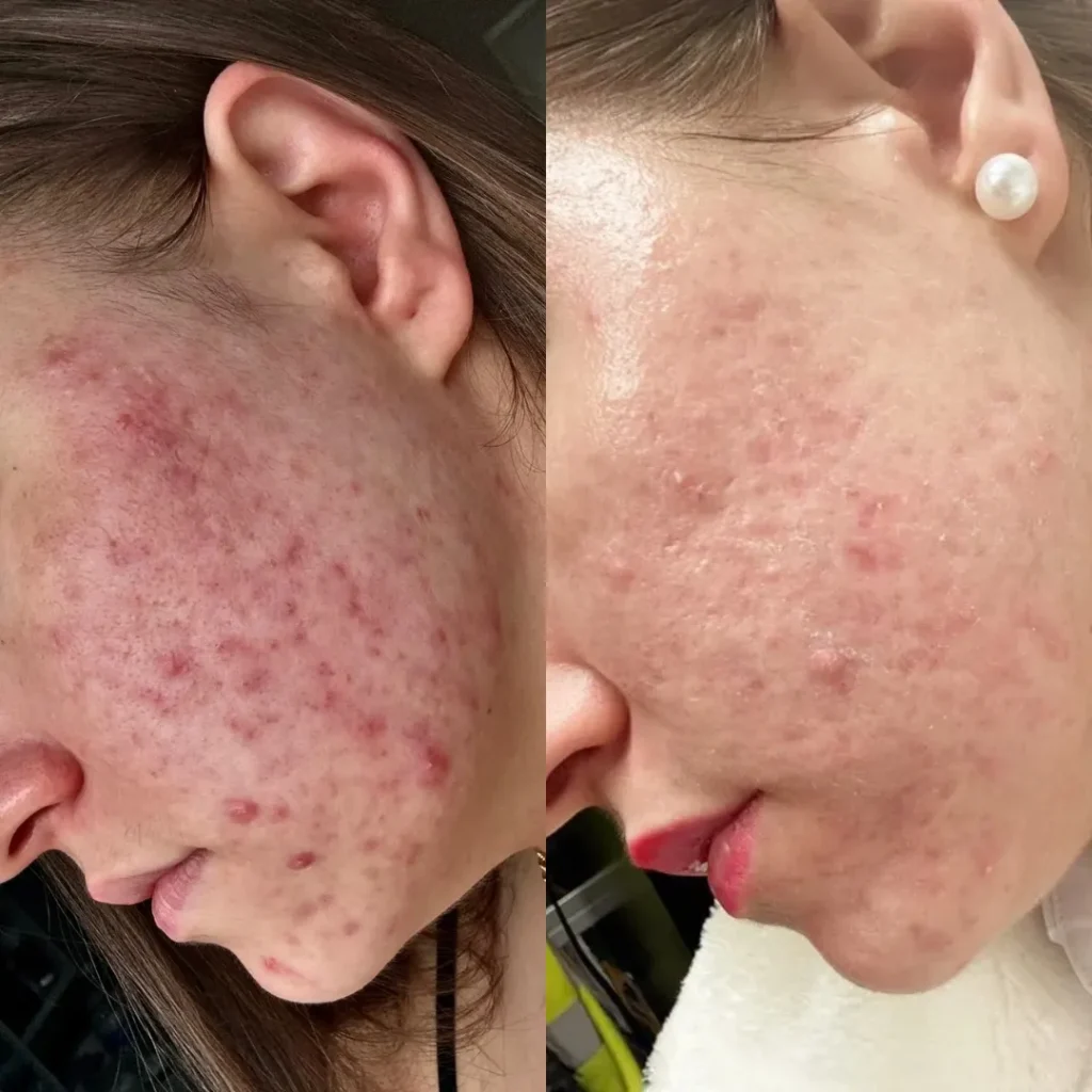 Acne Treatment in Harrow