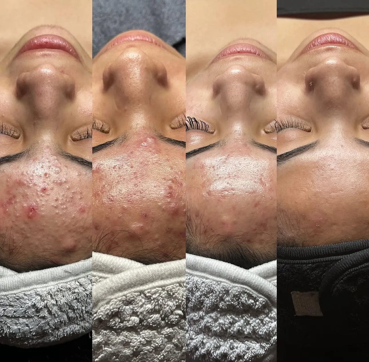 Acne Scar Treatment in Harrow on the Hill