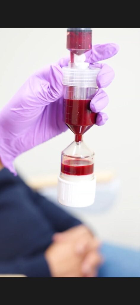 Autologous exosomes treatment for skin rejuvenation and hair growth in the UK