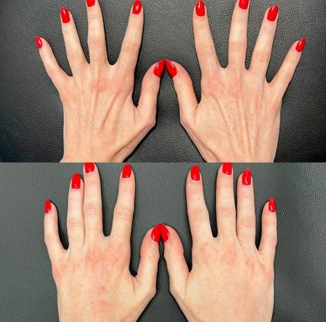 adavance-hand-treatment
