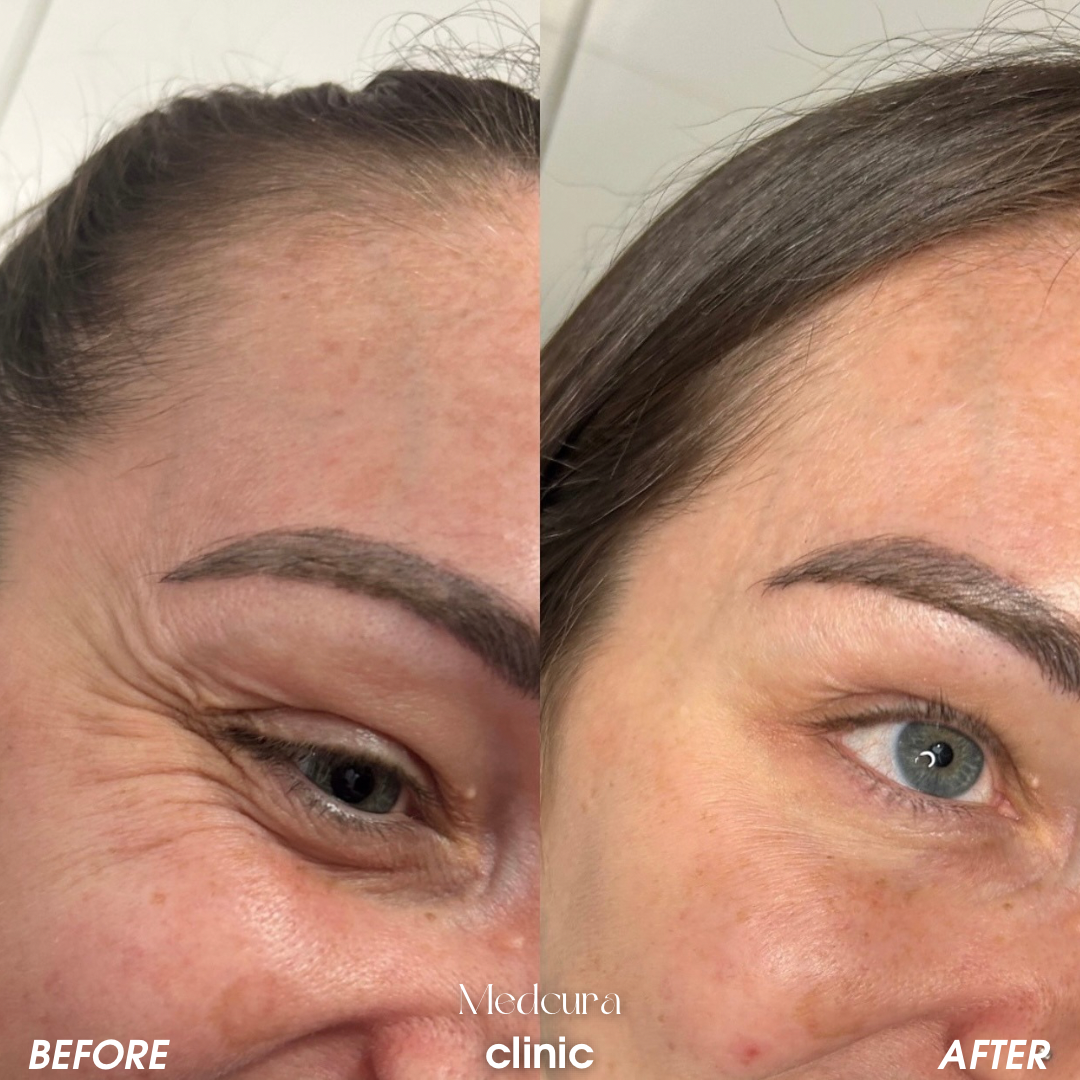 anti wrinkle injections