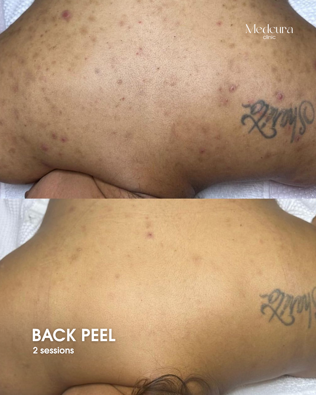 back peel