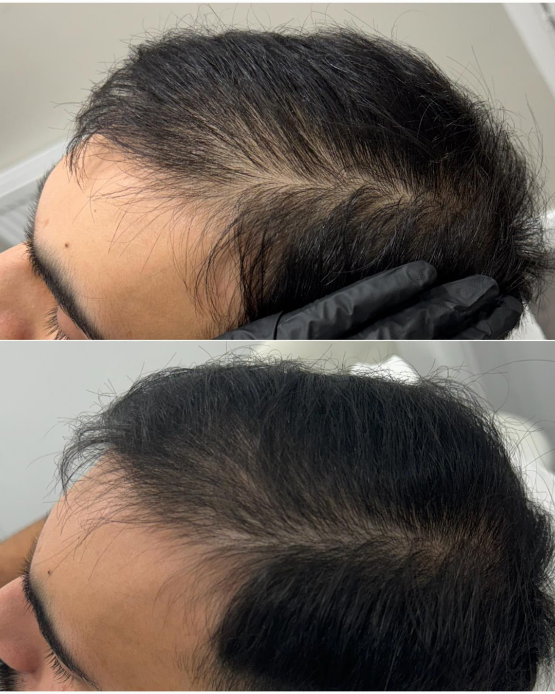 prp hair restoration