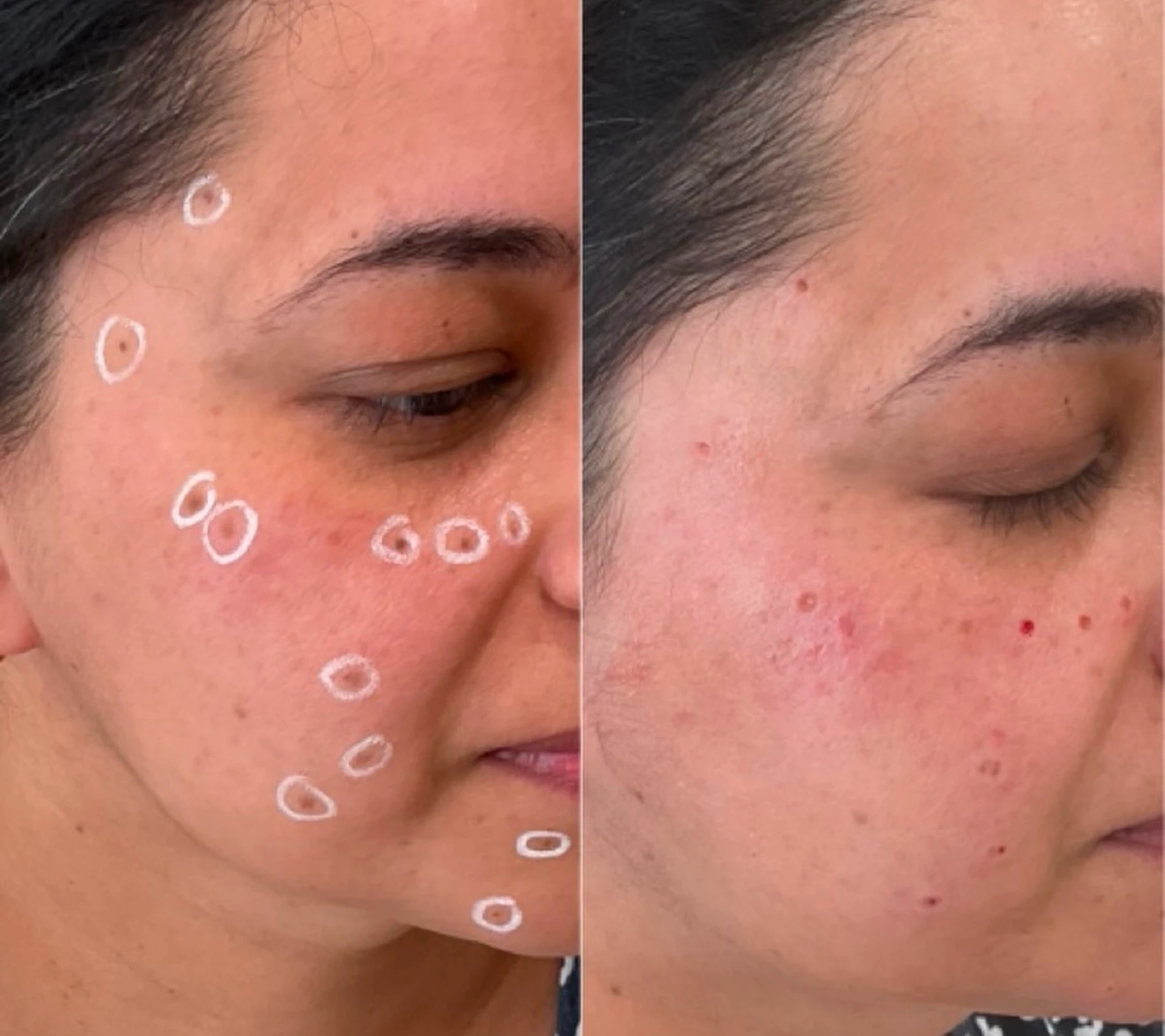 Acne Scarring