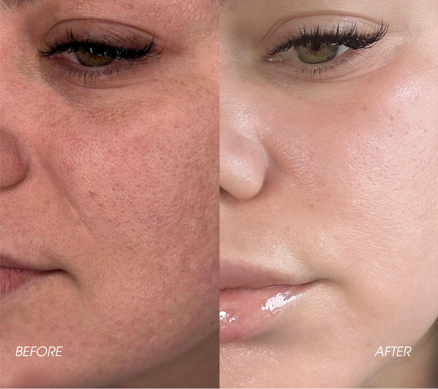 Dermal Fillers