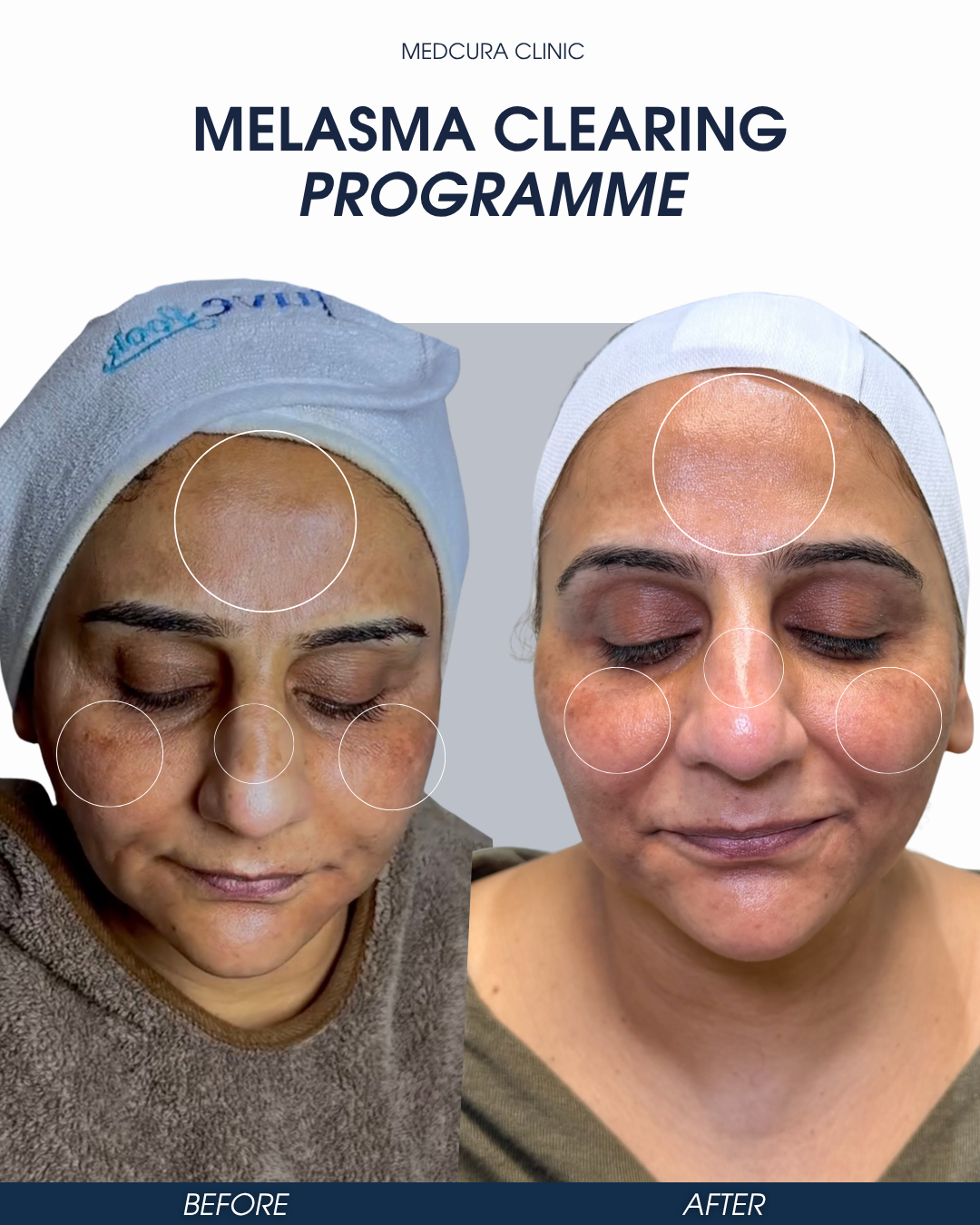 melasma clearing programme