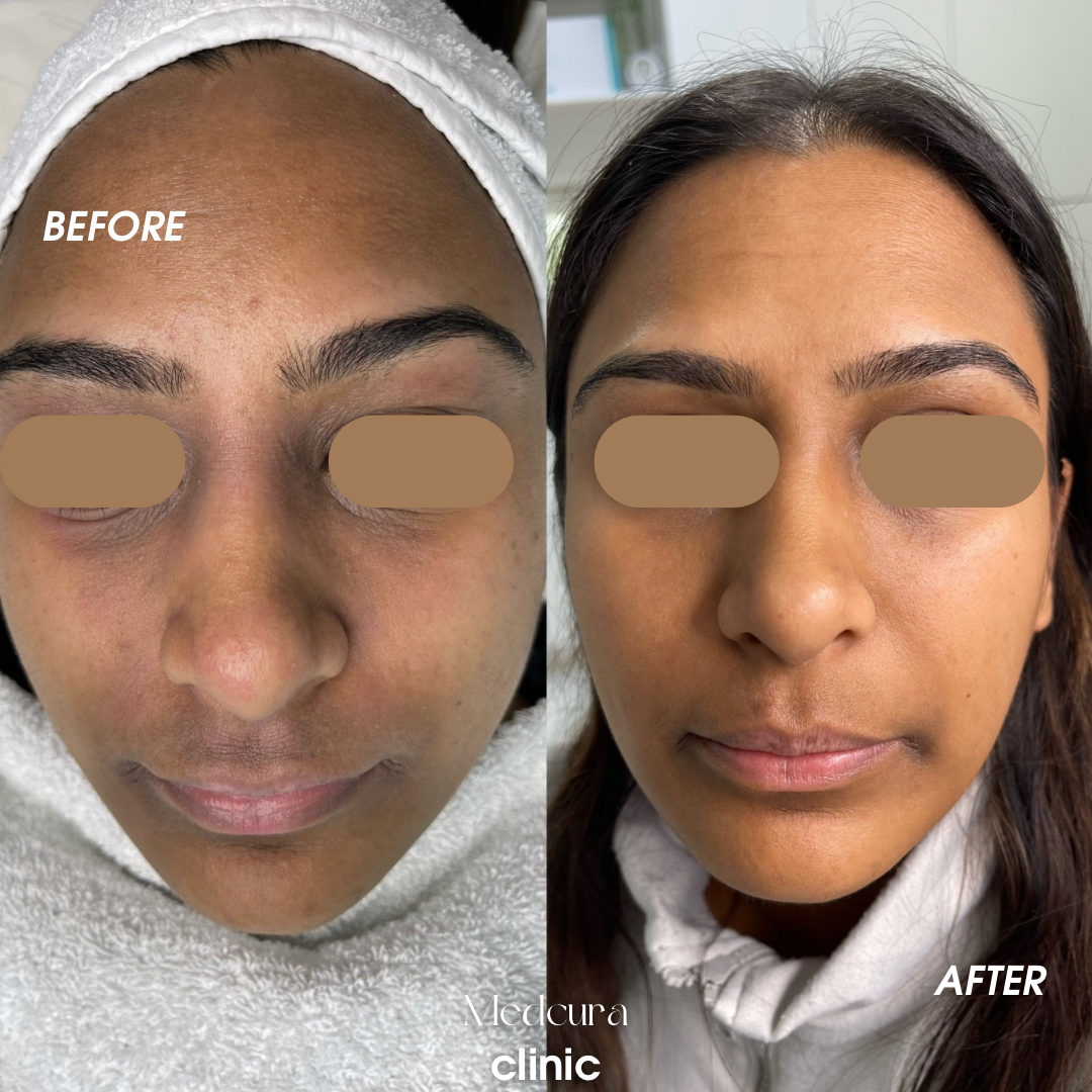 pigmentation removal with microneedling exosomes